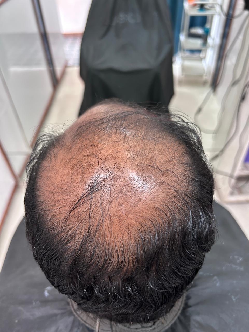 Hair Bonding for Men